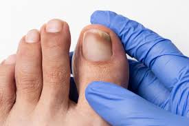 Understanding Toenail Fungus